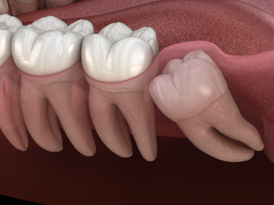 Impacted wisdom tooth from Lakewood Dental Arts in Lakewood, CA