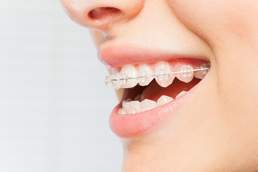 A close up of a smile with braces