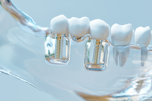 Photograph of multiple dental implants from Lakewood Dental Arts in Lakewood, CA