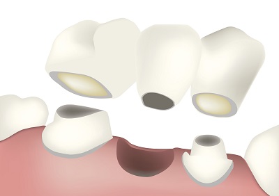 Restore Your Complete Smile With a Dental Bridge