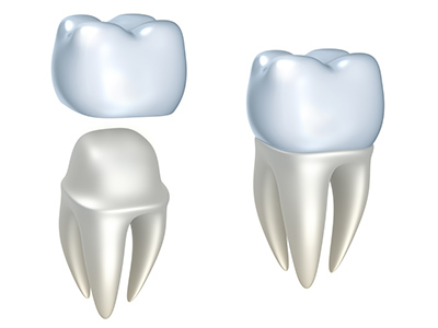 Dental Crowns and How They Help Your Teeth