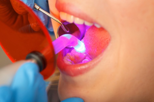 Do You Need Dental Bonding?
