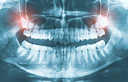 X-ray image of wisdom teeth.