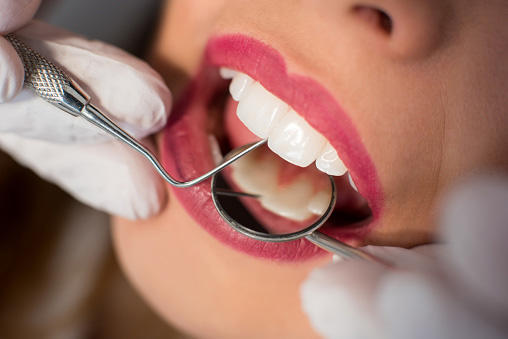 Close up of woman having dental check up after tooth whitening