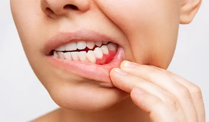 Close up of patient pulling down bottom lip at Lakewood Dental Arts in Lakewood, CA