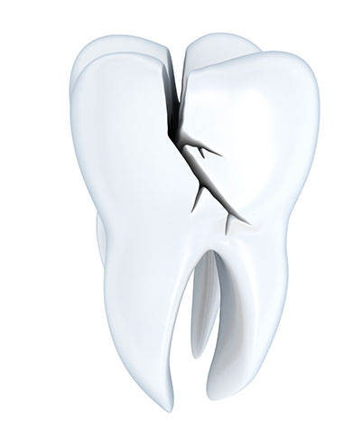 Cracked tooth: Types, causes, and treatments