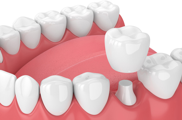 Rendering of jaw with dental crown at Lakewood Dental Arts in Lakewood, CA