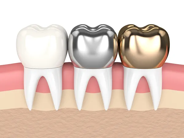 3D rendered cross-section view of three teeth with dental crowns made of different materials at Lakewood Dental Arts in Lakewood, CA