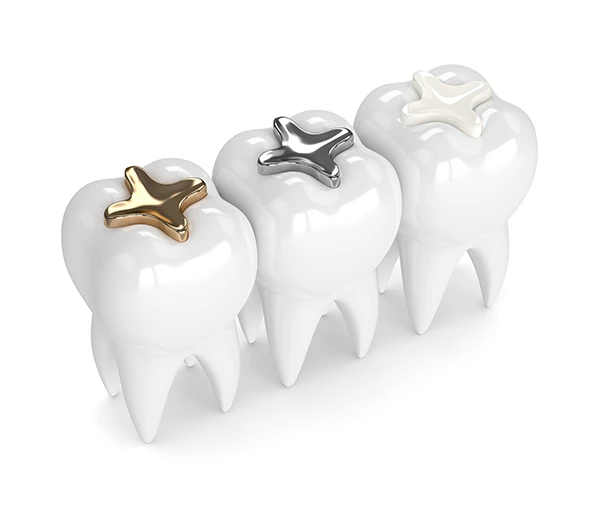 3D rendering of three teeth each with a different dental filling material: composite, amalgam, and gold at Lakewood Dental Arts in Lakewood, CA