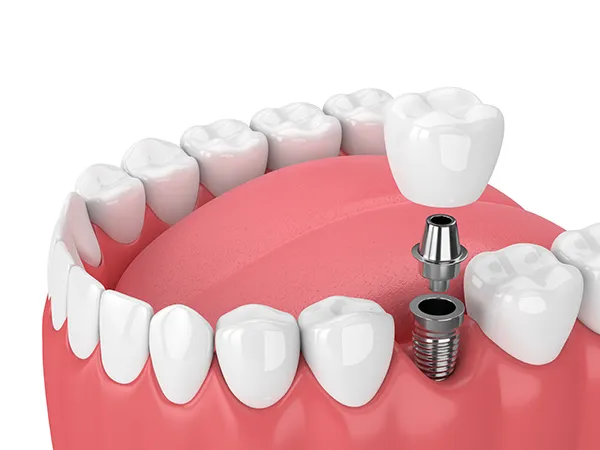 3D rendering of a dental implant and its components being placed into the jaw illustrated by Lakewood Dental Arts in Lakewood, CA