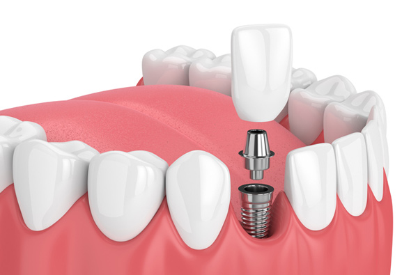 Rendering of jaw with dental implant at Lakewood Dental Arts in Lakewood, CA