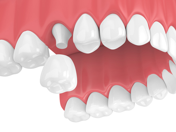 Rendering of jaw with dental crown from Lakewood Dental Arts in Lakewood, CA