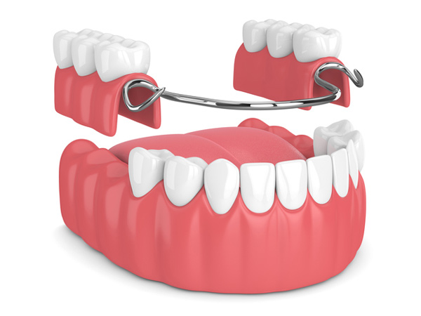 Rendering of removable partial denture from Lakewood Dental Arts in Lakewood, CA