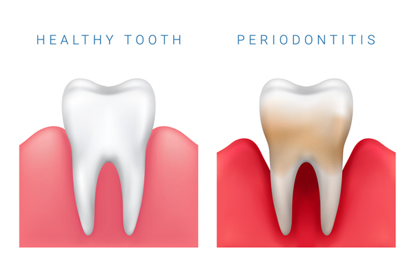 Diagram of healthy tooth compared to periodontitis diseased tooth at Lakewood Dental Arts