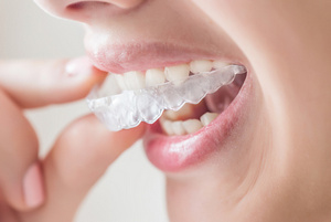Photograpgh of person with Invisalign aligner at Lakewood Dental Arts in Lakewood, CA